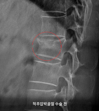 수술 전