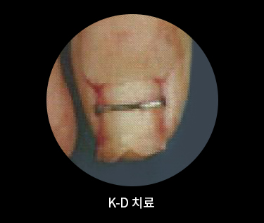 K-D 치료