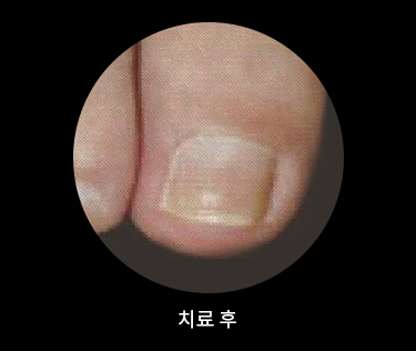 치료 후