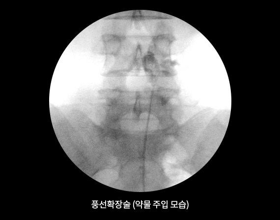 인공관절 수술 후