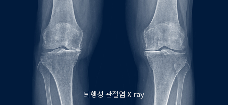 퇴행성관절염