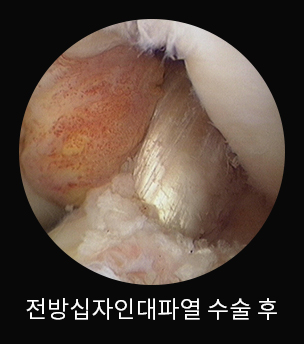 수술 후