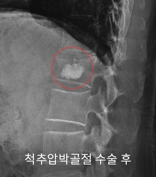 수술 후