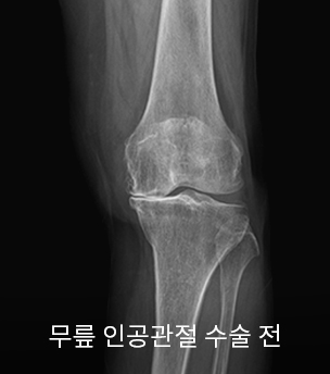 수술 전