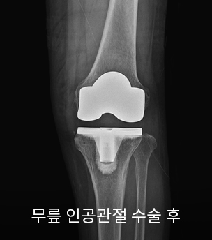 수술 전