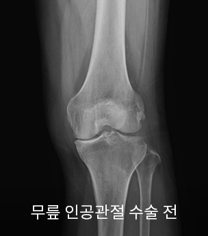 수술 전