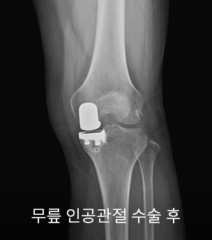 수술 전