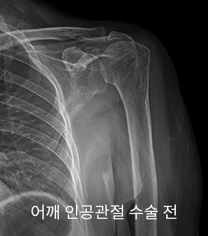 수술 전
