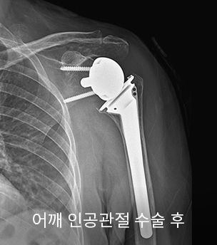 수술 전