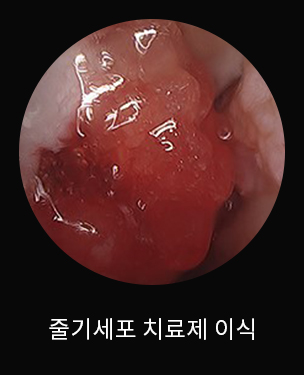 수술 후