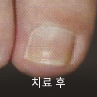 치료 후