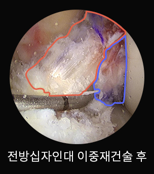 수술 전
